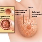 Laktostaz-, hogyan kell kezelni a stagnálás tej, zayplyushki