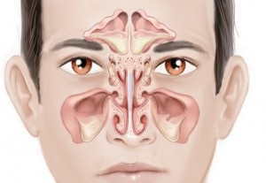 A kezelés kezdeti szakaszában sinusitis, mind a kezelés arcüreggyulladás