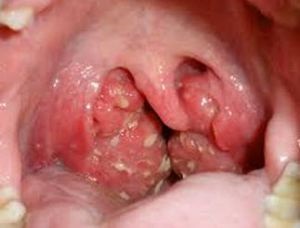 Leptotrichosis (faringomikoz) okoz, tünetei és kezelése, mi köze van a reprodukciós leptotriksa