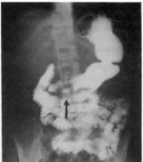 Diagnosztikai módszerek a gyomorrák (morfológiai ellenőrzése diagnózis) Diagnosztikai módszerek a gyomorrák
