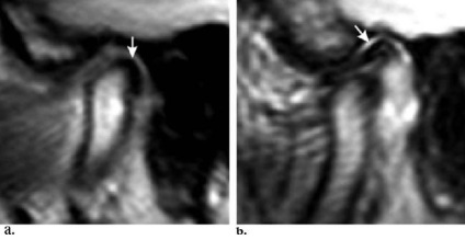 Szakértő MRI, MRI az állkapocsízület (TMJ)