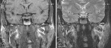 Szakértő MRI, MRI az állkapocsízület (TMJ)