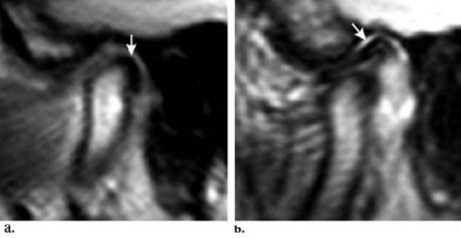 Szakértő MRI, MRI az állkapocsízület (TMJ)