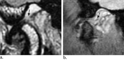 Szakértő MRI, MRI az állkapocsízület (TMJ)