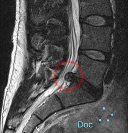 MRI (ellenőrzés) a gerinc, hogy az eljárás