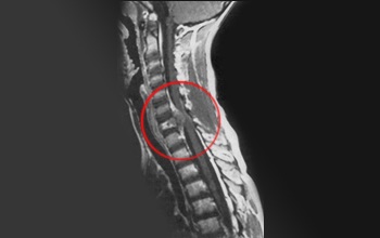 MRI (ellenőrzés) a gerinc, hogy az eljárás