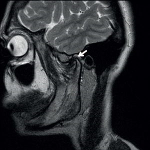 MRI az állkapocsízület (TMJ), amely azt mutatja, a ciszta