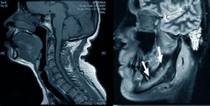 MRI az állkapocsízület (TMJ), amely azt mutatja, a ciszta