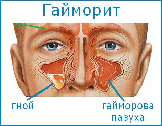 A kezdeti szakaszban a sinusitis, hogyan lehet felismerni és kezelni