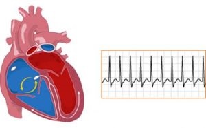 A supraventricularis tachycardia, rohamokban és jellemzői
