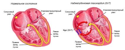 A supraventricularis tachycardia okoz, tünetei és kezelése roham