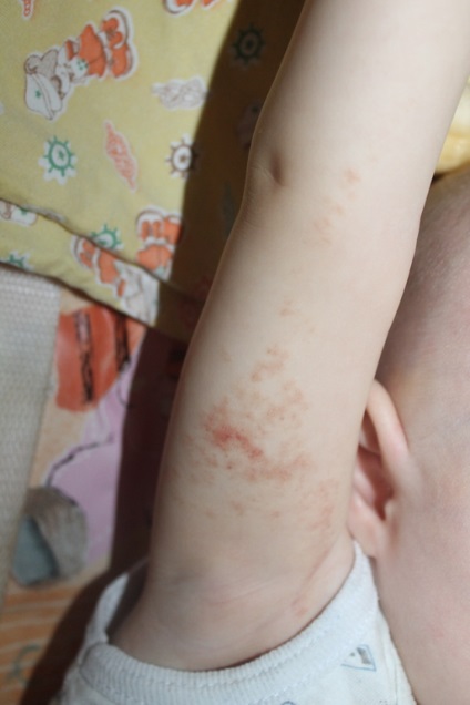 Atópiás dermatitis a kezében előfordulása mechanizmus, tünetei és kezelési módszerek (neurodermitis fotó a kezét) Az atópiás dermatitis a kezében előfordulása mechanizmus, tünetei és kezelési módszerek