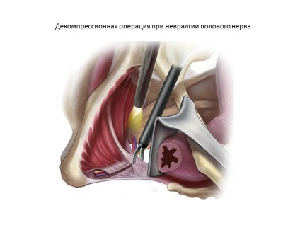 Neuropathia szexuális (szeméremtest) ideg krasnodare, klinika és uroginekologii neyrourologii