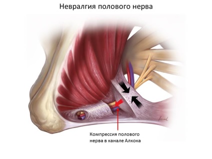 Neuropathia szexuális (szeméremtest) ideg krasnodare, klinika és uroginekologii neyrourologii