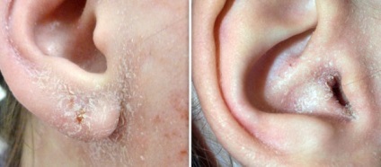 Korpásodás a füle okok és a kezelés