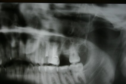 Odontogén ciszta maxillaris (maxilláris) szinuszok (maxilla) Odontogén ciszta maxillaris (maxillaris) sinus