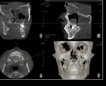 Odontogén ciszta maxillaris (maxillaris) sinus (ciszta) Odontogén ciszta maxillaris (maxillaris) sinus