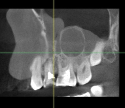 Odontogén ciszta maxillaris (maxilláris) szinuszok (maxilla) Odontogén ciszta maxillaris (maxillaris) sinus
