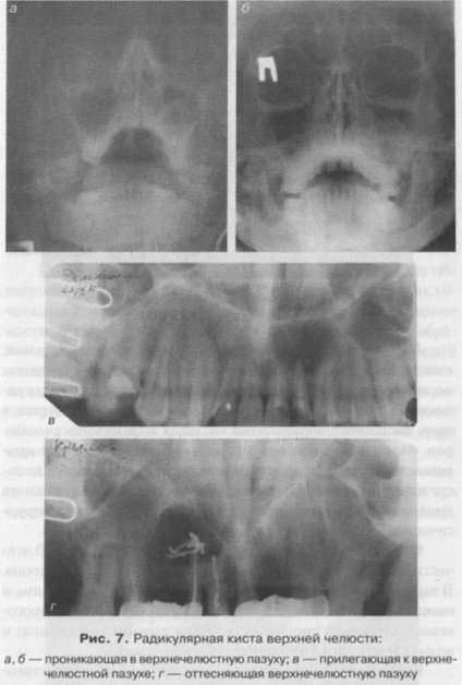 Odontogén tumorok és ciszták a felső és alsó állkapocs (ciszták) Odontogén tumorok és ciszták a felső és alsó állkapocs