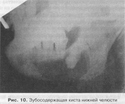 Odontogén tumorok és ciszták felső és alsó állkapcsának (rövid szénláncú) Odontogén tumorok és ciszták a felső és alsó állkapocs