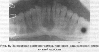 Odontogén tumorok és ciszták a felső és alsó állkapocs (fogeredetű) Odontogén tumorok és ciszták a felső és alsó állkapocs