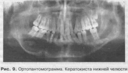 Odontogén tumorok és ciszták a felső és alsó állkapocs (fogeredetű) Odontogén tumorok és ciszták a felső és alsó állkapocs