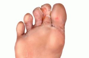 Kopás a lábujjak között okok és a kezelés