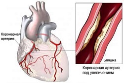 Akut koronária szindróma - gyógyításában, diagnosztizálásában, okai