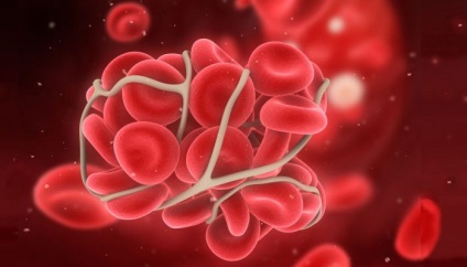 Placenta leválás a terhesség korai szakaszában okoz, a tünetek, a kezelés (leválás) Placenta leválás a terhesség korai szakaszában okoz, a tünetek, a kezelés