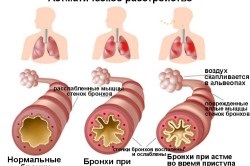 Perzisztáló asztma kezelésére