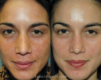 Peeling nyári következmények nélkül (arc peeling nyáron) Peeling nyári következmények nélkül