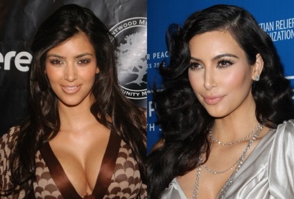 A plasztikai sebészet Kim Kardashian műanyagok Kim Kardashian