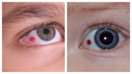 Miért volt egy piros folt a szem kezelésére