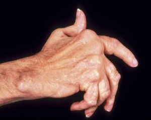 Polyosteoarthrosis kéz ízületeit