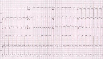 Interferencia EKG