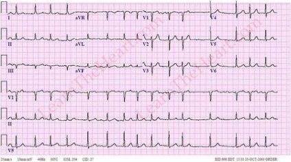 Interferencia EKG