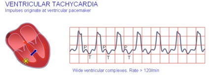 Interferencia az elektrokardiogramon (magasság fibrilláció hullámok) Interferencia EKG