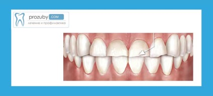 Fokozott fogászati ​​kopás - tünetek és kezelési módszerek