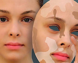 Okok, tünetek és kezelések vitiligo (tünetek) Okai, tünetei és kezelése vitiligo