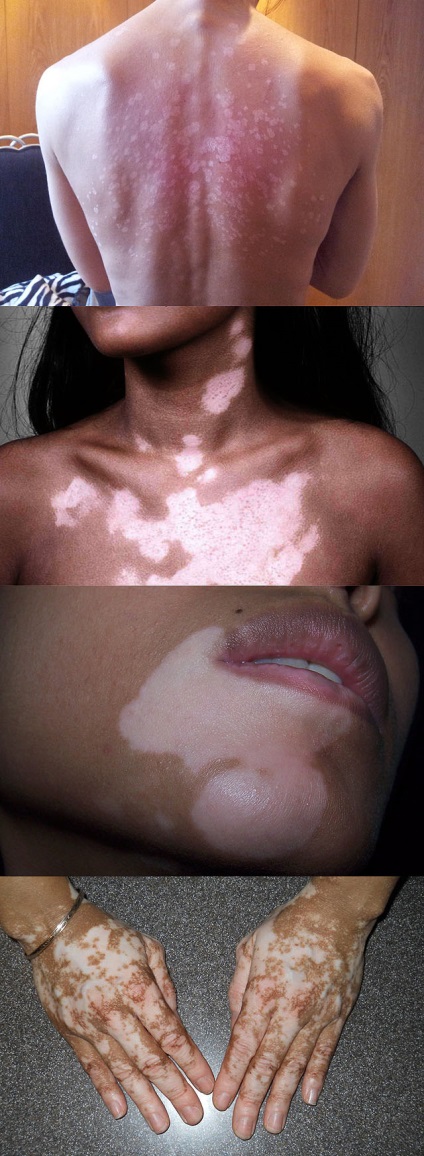 Okai, tünetei és kezelése vitiligo