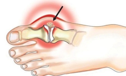 fájdalom térdízületi kezelés közben térdízület első fokú osteoarthrosis