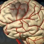Sztrókmegeiőzés étrend az agyi stroke-