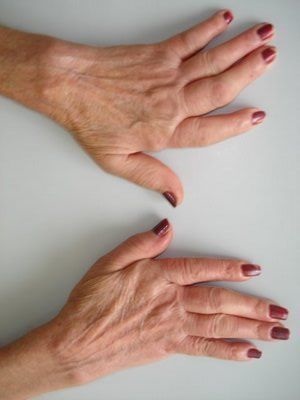 A rheumatoid arthritis diagnózis, a tünetek, a kezelés