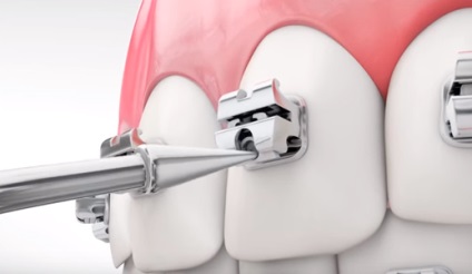 Önszabályozó (bezligaturnye) zárójelek (fogszabályozó) Önszabályozó (bezligaturnye) Braces