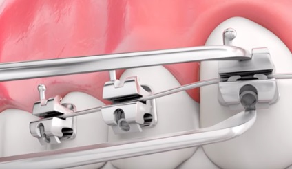 Önszabályozó (bezligaturnye) zárójelek (fogszabályozó) Önszabályozó (bezligaturnye) Braces