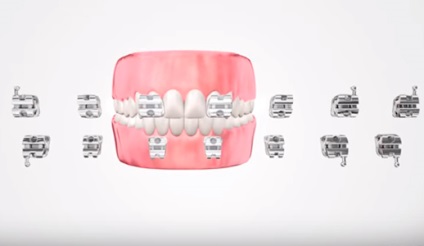 Önszabályozó (bezligaturnye) Braces