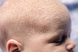 Seborrhoeás dermatitis csecsemők okoz az újszülöttkori kezelés