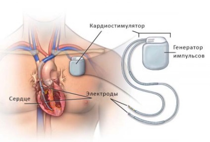 Sick sinus szindróma tünetei, diagnózisa és kezelése