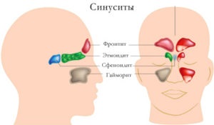 Az orrmelléküreg-gyulladás-oldalú, hogy kétoldalas akut sinusitis