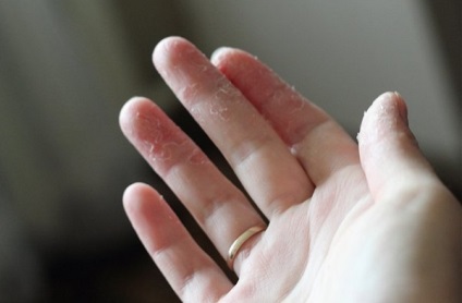 Húzza le a bőrt az ujjai az okok és a kezelés a kéz